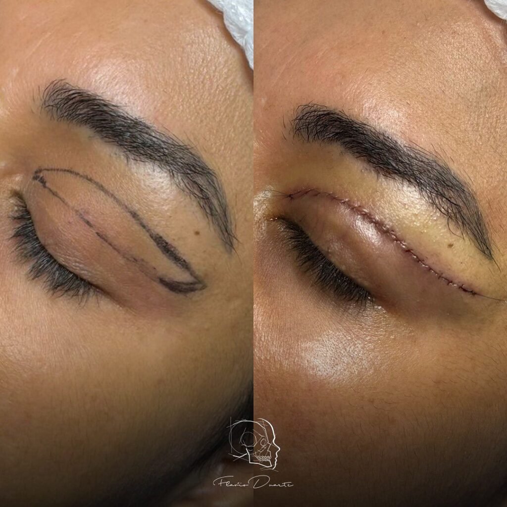 blefaroplastia cirurgia