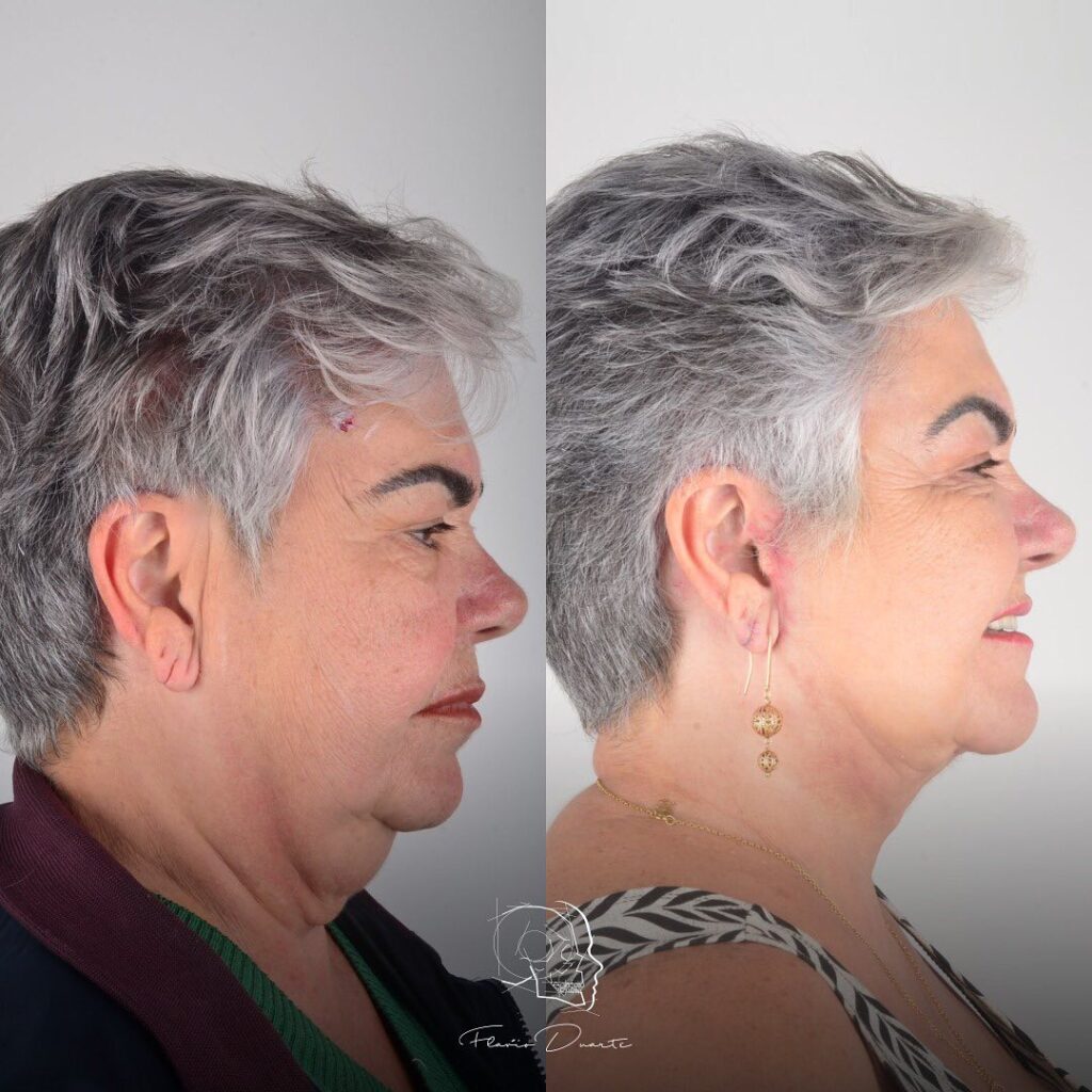 Resultado lifting facial deep plane