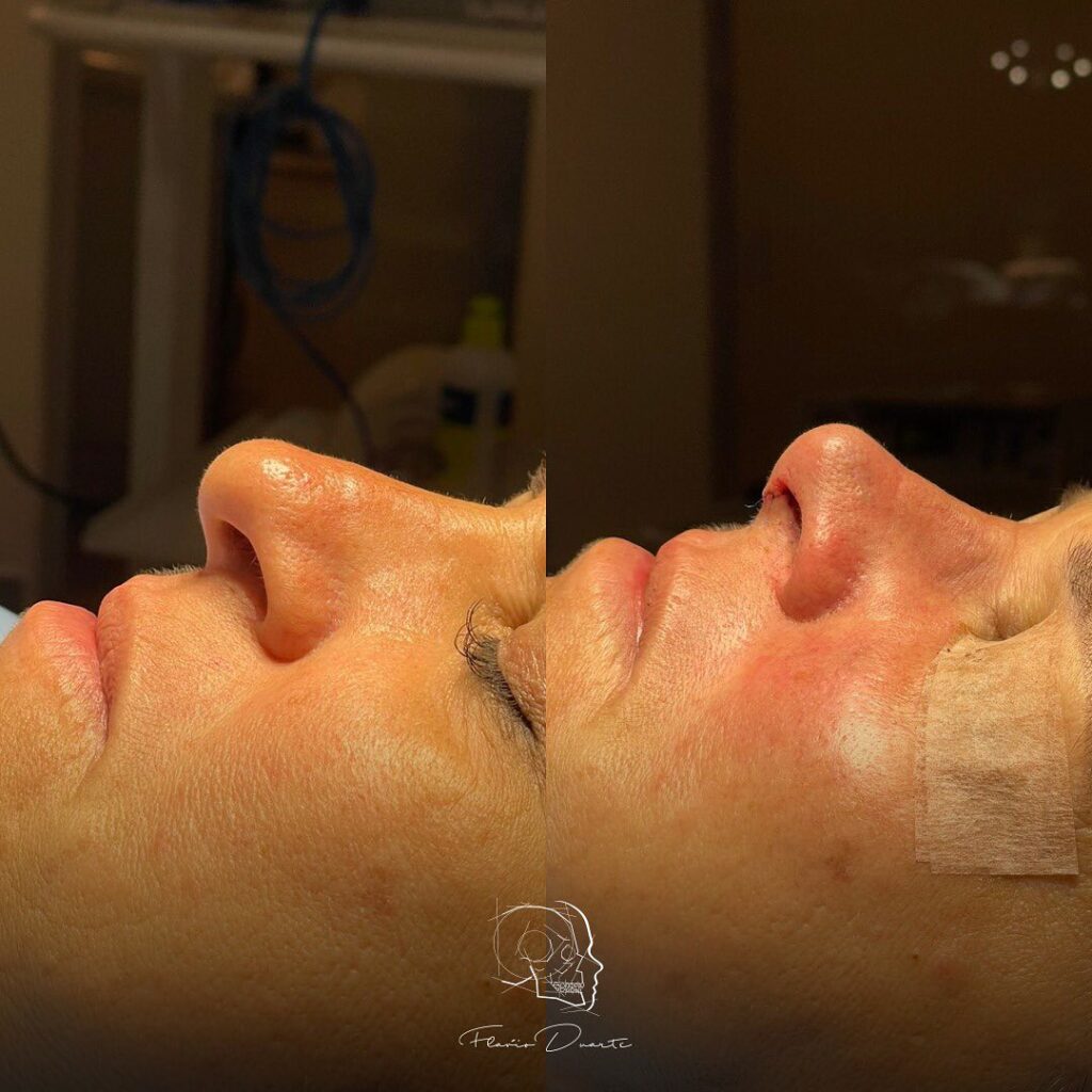 rinoplastia para resultados naturais