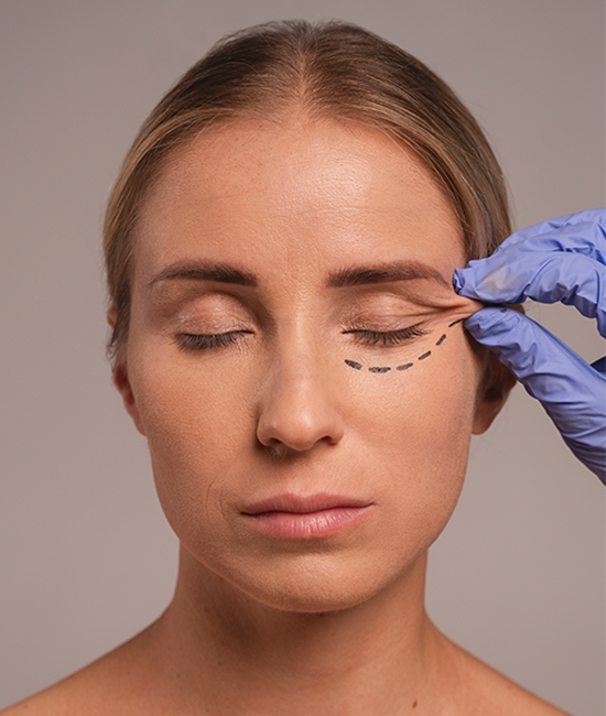 blefaroplastia-cirurgia-palpebras